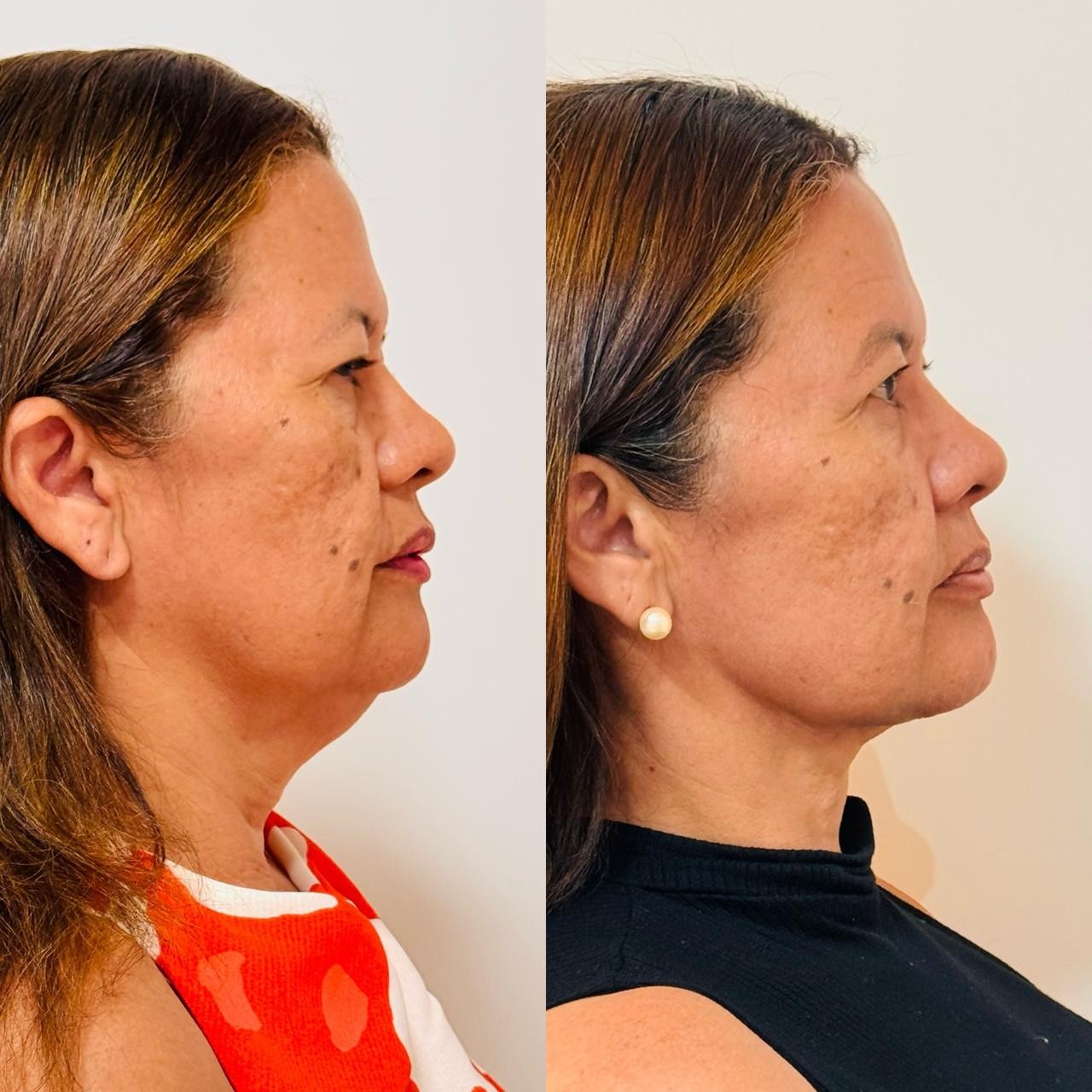 Antes e depois deLipo de Papada